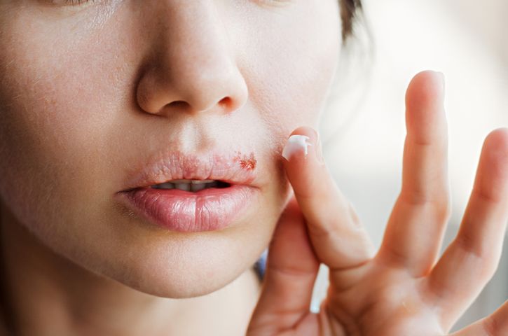 Opryszczka na ustach wywoływana jest przez wirus opryszczki