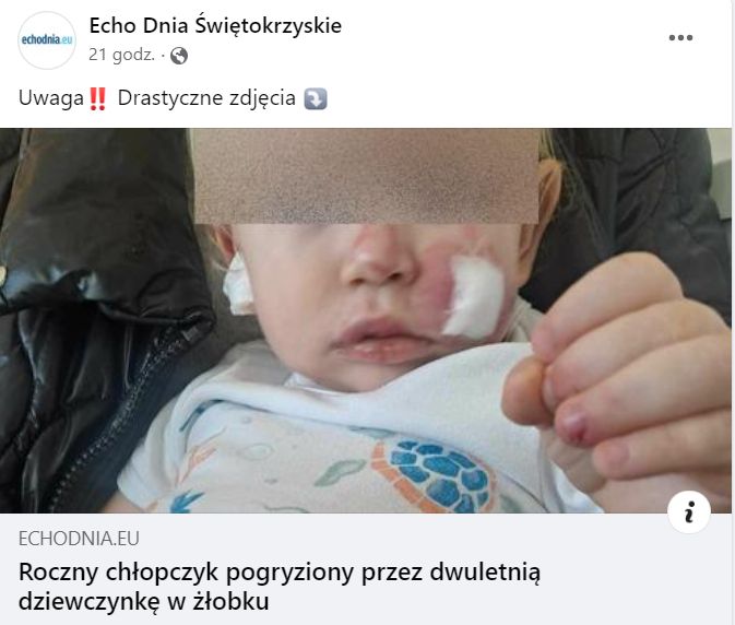 Dziecko pogryzione w żłobku