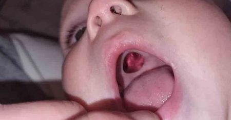 Zobaczyła dziurę w podniebieniu niemowlaka. Młoda mama natychmiast zabrała go do szpitala