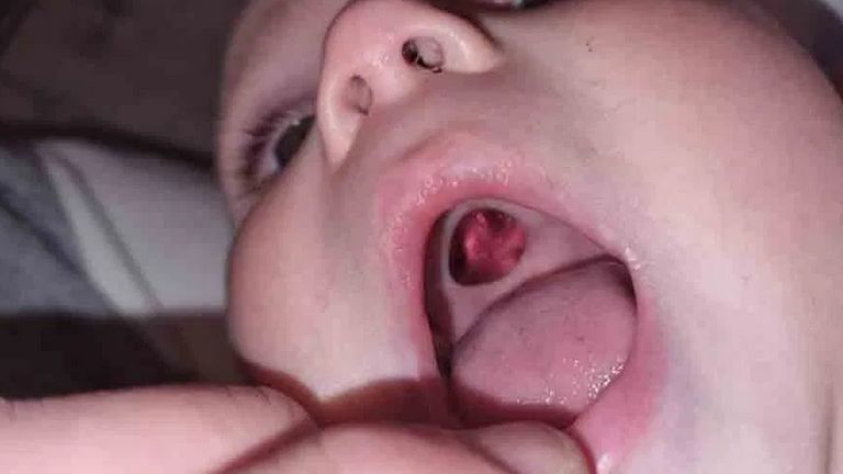 W jego podniebieniu była dziura. Młoda mama spanikowała