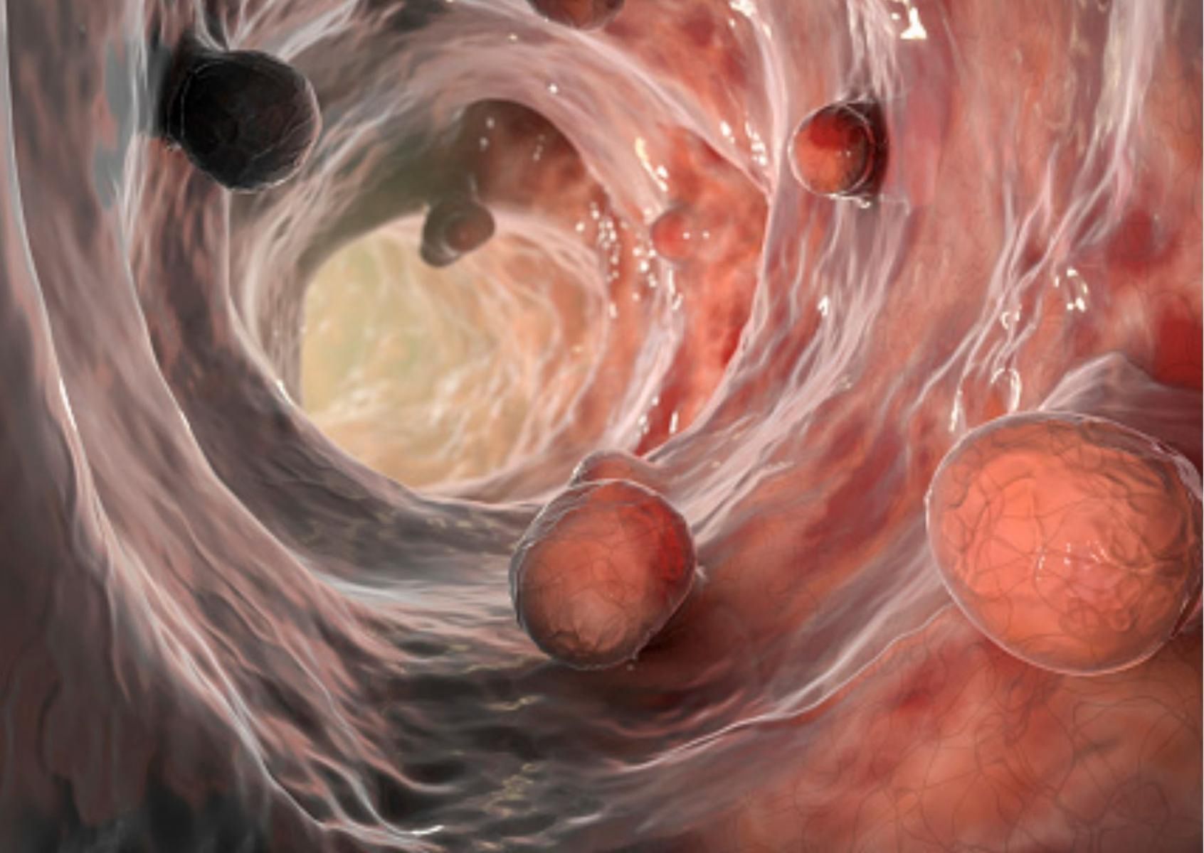 Zbyt częste przyjmowanie antybiotyków może wywołać grzybicę jelit