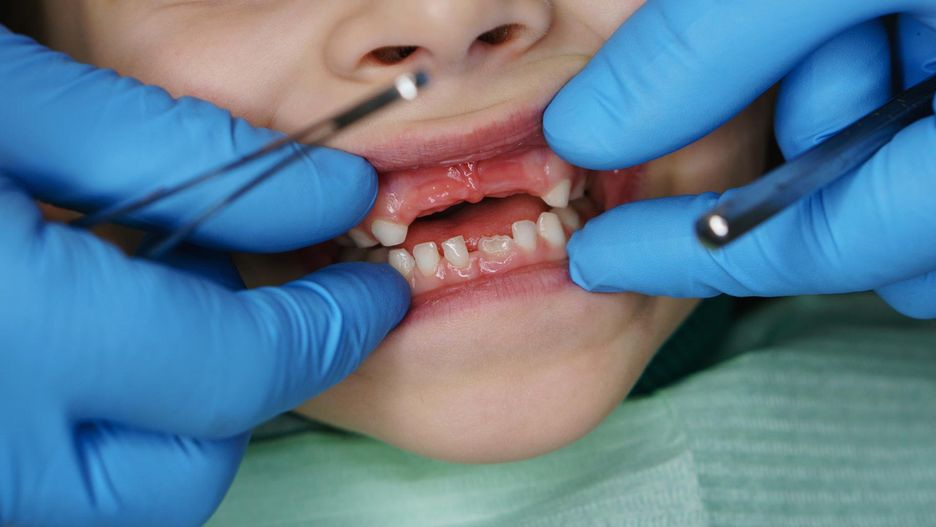Białe plamki na zębach dziecka mogą być znakiem MIH