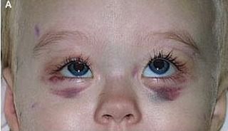 Zasinienie wokół oczu może być sygnałem alarmowym