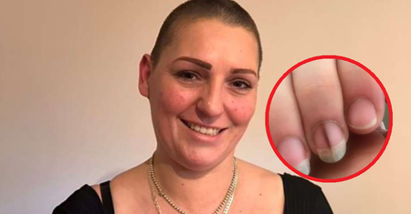 Zaczęło się od niewinnej zmiany na paznokciu. 38-latka walczy z guzem mózgu