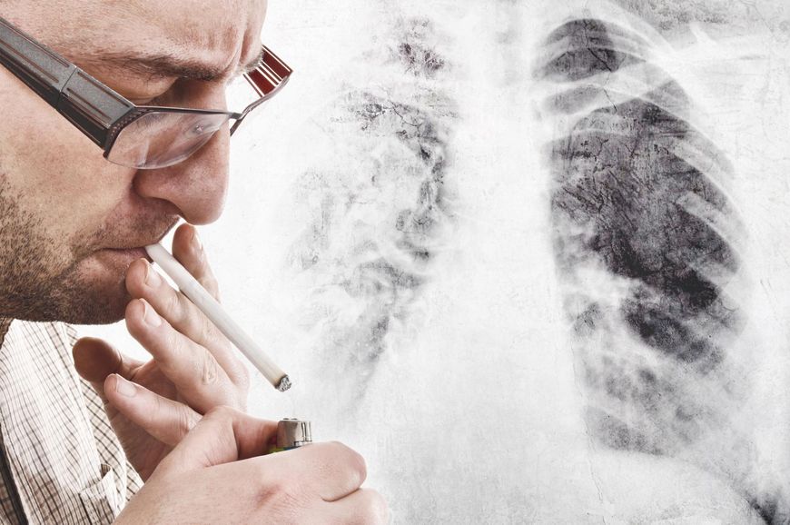 Rak płuc co roku zabija wiele osób