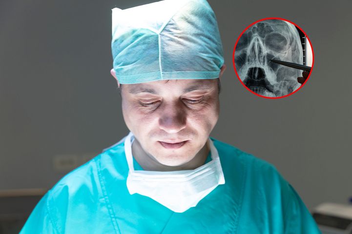 Przez 30 lat lekarze nie odkryli, że ma kamienie nosowe