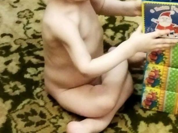 Dzieci mają zdeformowane kończyny