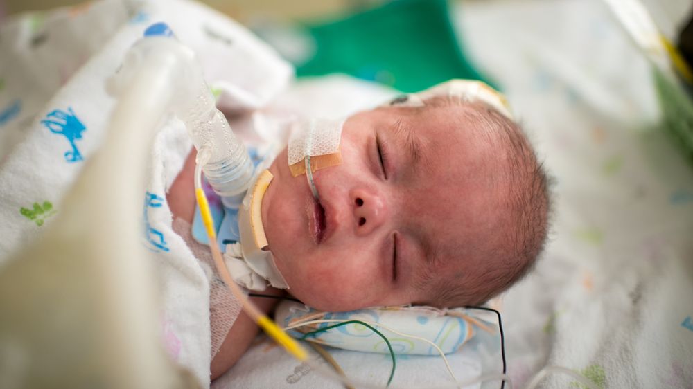 Zespół Edwardsa występuje raz na blisko 3 tys. urodzeń żywych dzieci