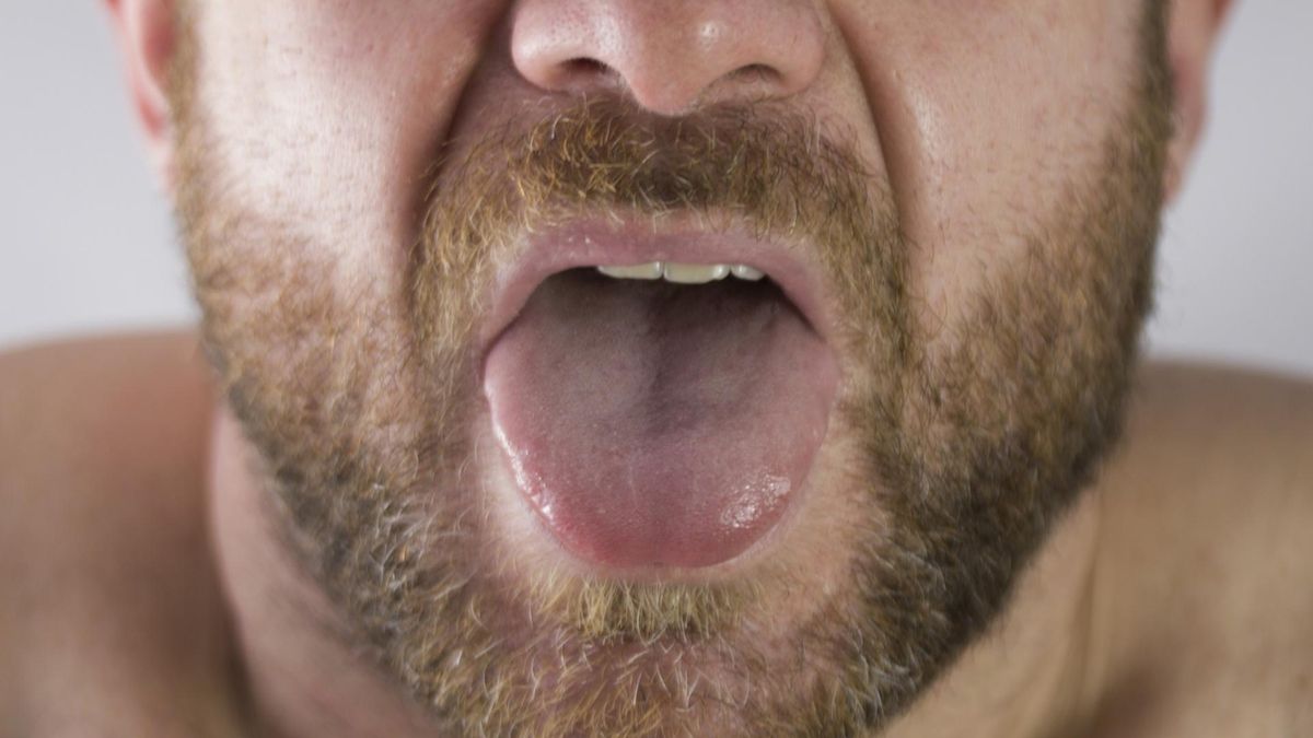 Owrzodzenie języka może być objawem koronawirusa