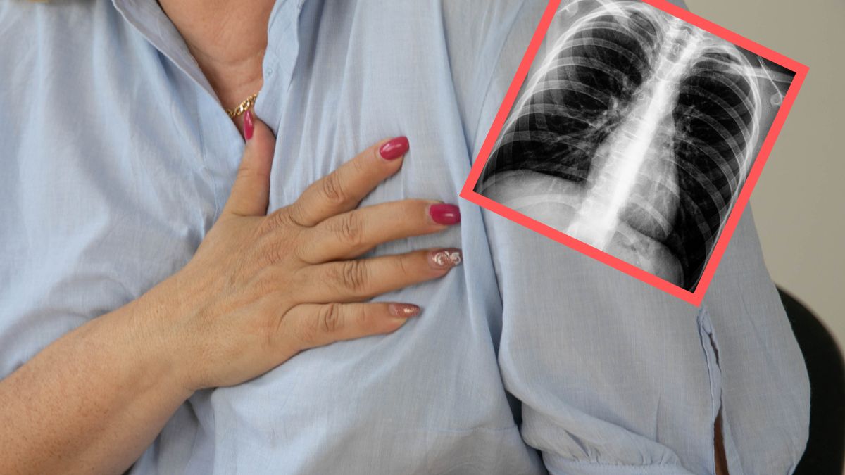 Mało charakterystyczne objawy raka płuc