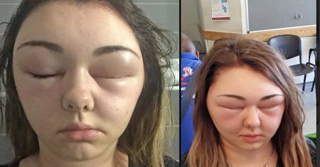 Alergia na farbę do włosów. Kobieta prawie oślepła