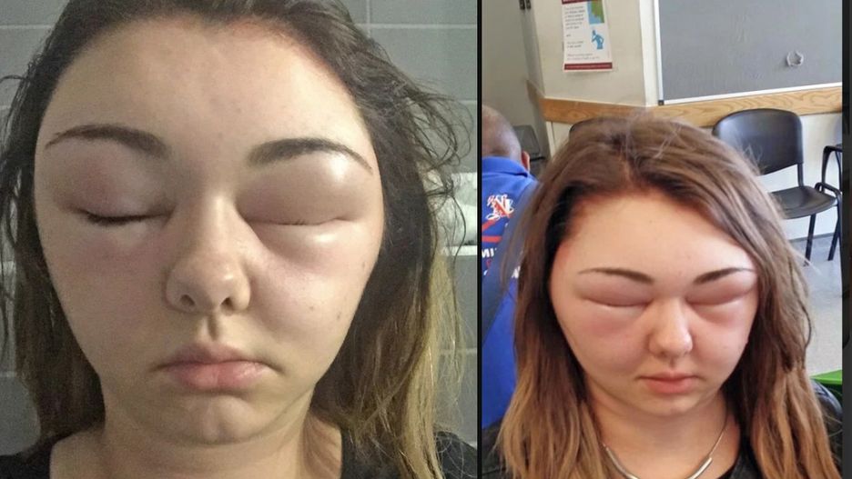 Alergia na farbę do włosów może powodować opuchliznę twarzy, obrzęk głowy, czasową utratę wzroku i duszności