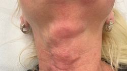 Ofiary zabiegów upiększających. "Pacjentka przez trzy miesiące była tak zapuchnięta, że nie była w stanie otwierać oczu"