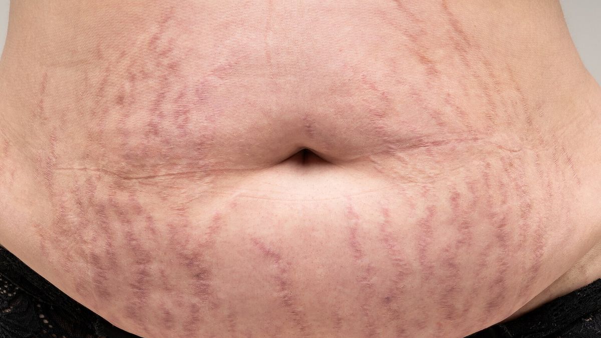 Masz takie blizny na brzuchu? Tak może się objawiać choroba hormonalna