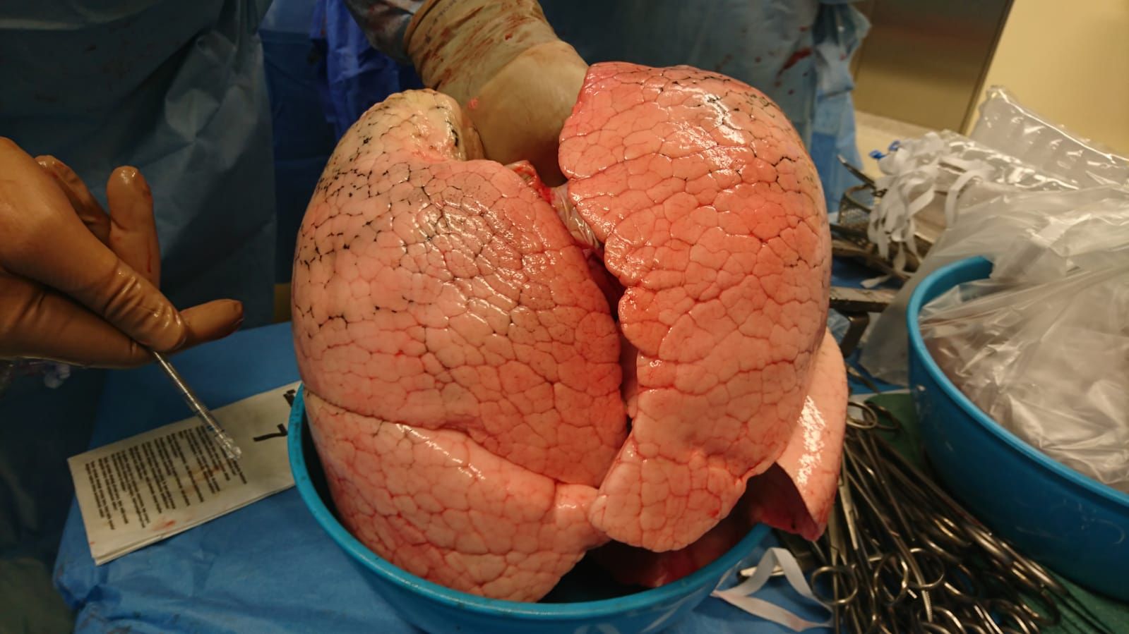 Zdrowe płuca dawcy w trakcie przygotowania do przeszczepienia 