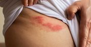 Półpasiec – przyczyny, objawy, rodzaje, leczenie, ciąża