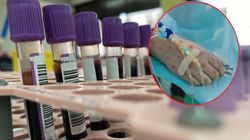 Nowe objawy małpiej ospy. Na to najczęściej skarżą się chorzy