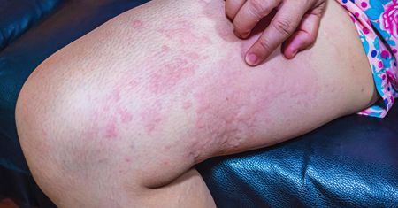 Dermatologiczne objawy COVID-19. Zmiany na języku, stopach i dłoniach