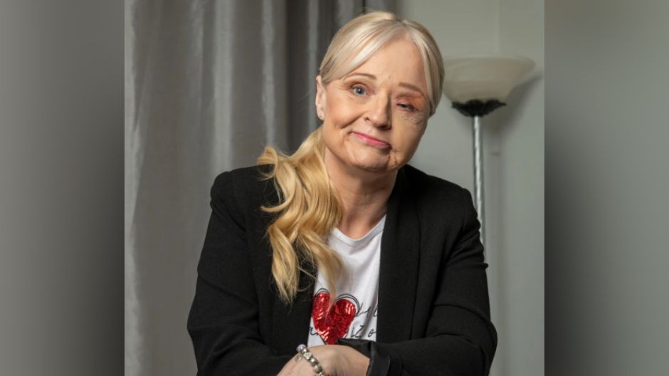 Donna Corden straciła połowę twarzy