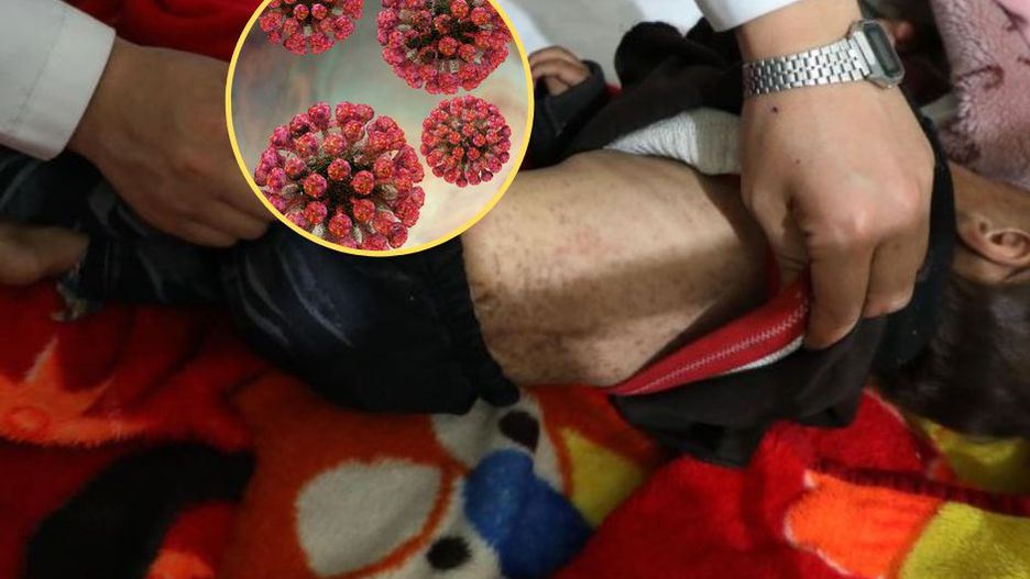 30-krotny wzrost zachorowań na odrę. WHO bije na alarm