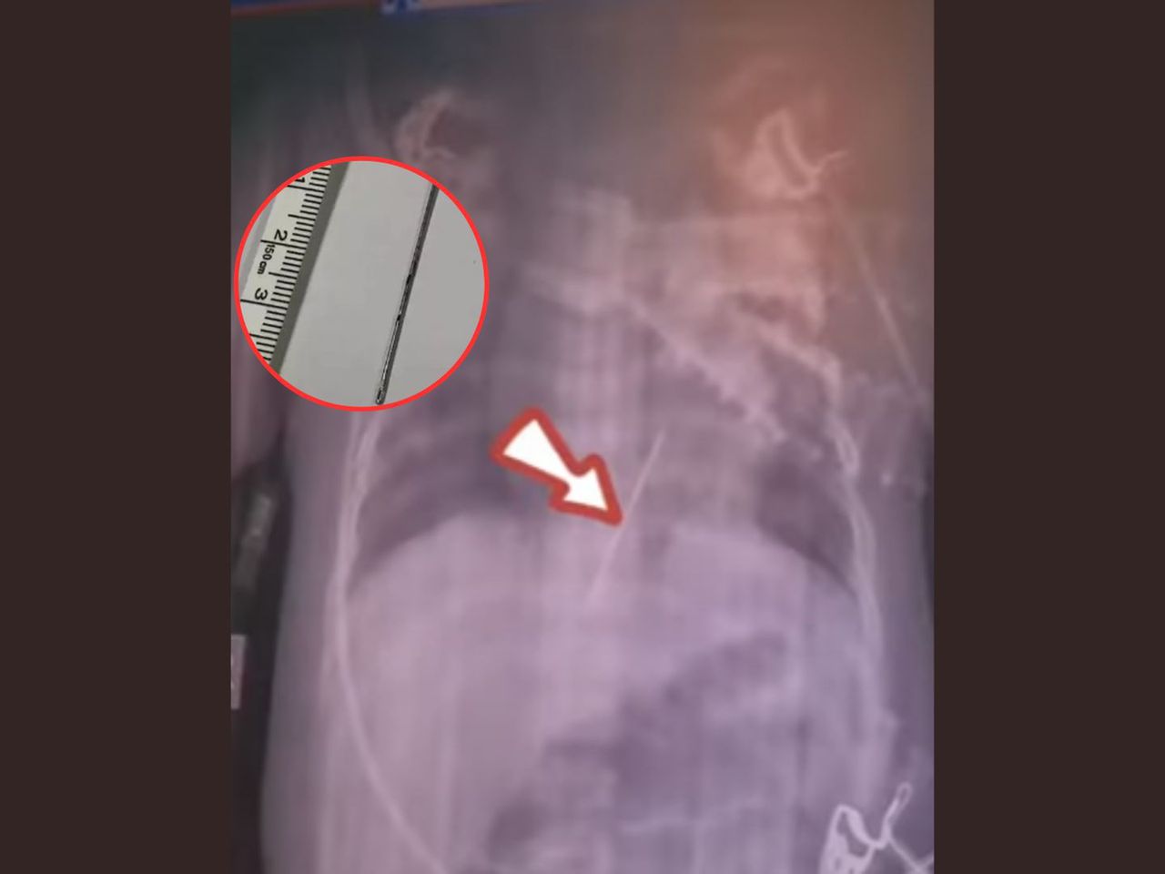 Lekarze zamarli, gdy zobaczyli zdjęcie. Igła wbiła się dziecku w serce