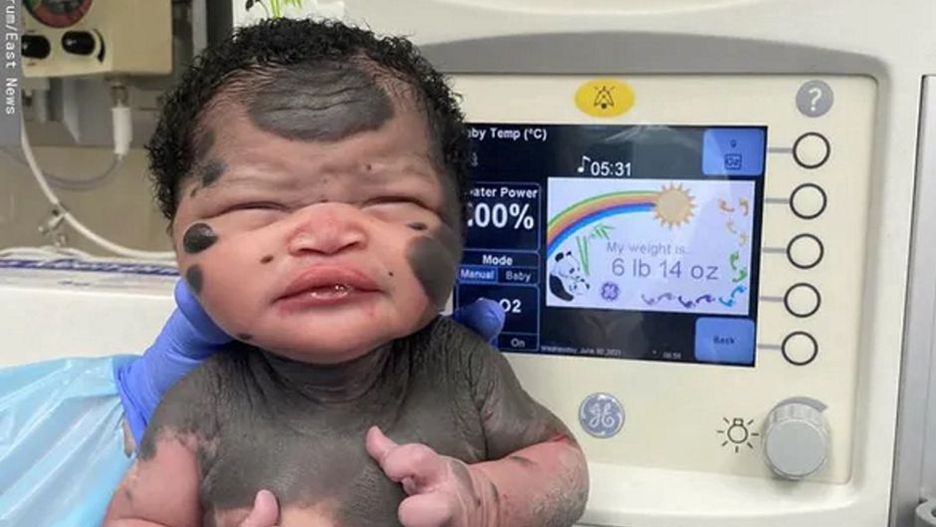 Słynna "dziewczynka-panda" skończyła 3 lata. Bardzo się zmieniła