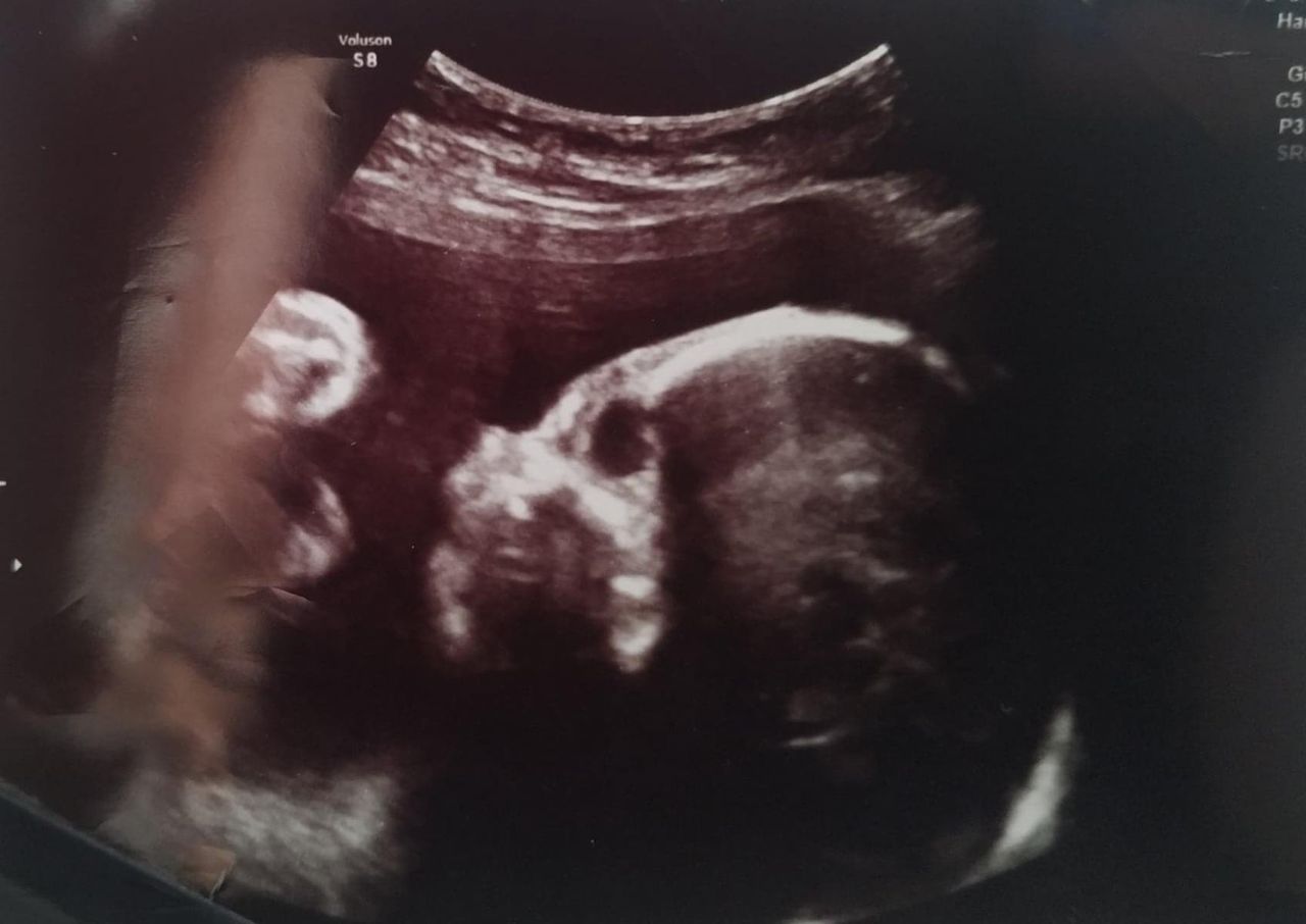 Lekarze namawiali ją do aborcji. Urodziła dziecko z zespołem Edwardsa