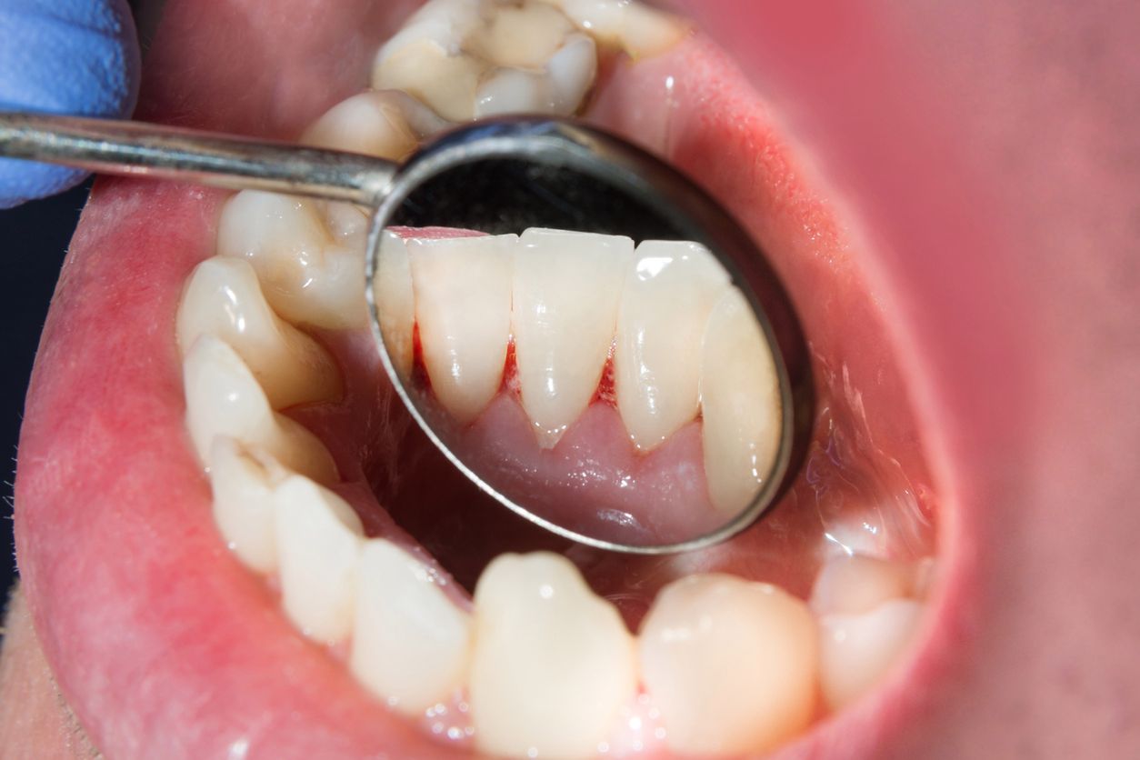 Szkliwiak pojawia się w pobliżu zębów trzonowych w tyle żuchwy