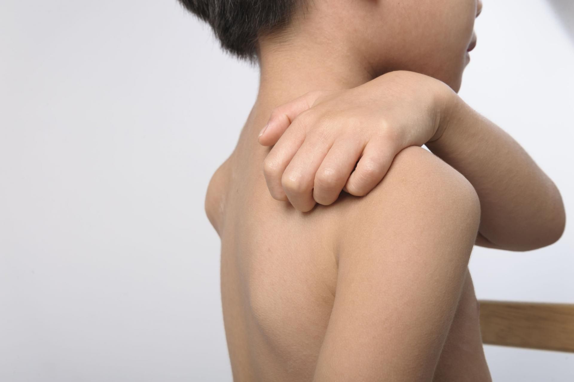 Objawem pokrzywki są swędzące plamy na skórze