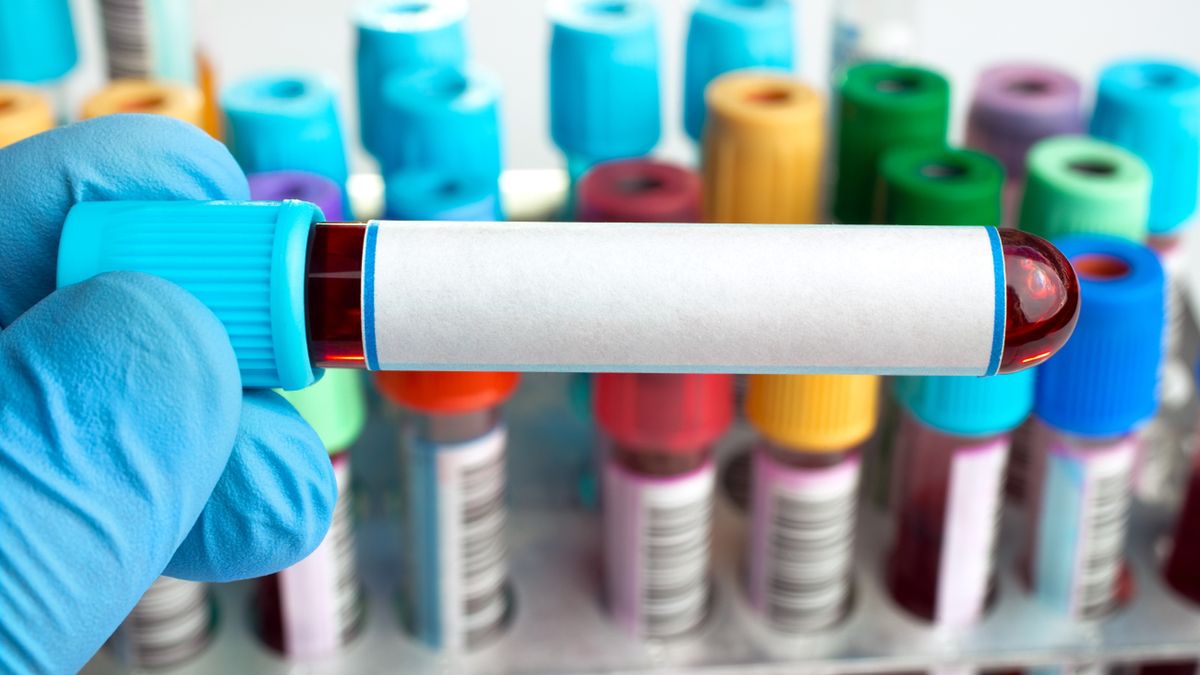 Hipertriglicerydemia oznacza wysoki poziom trójglicerydów we krwi