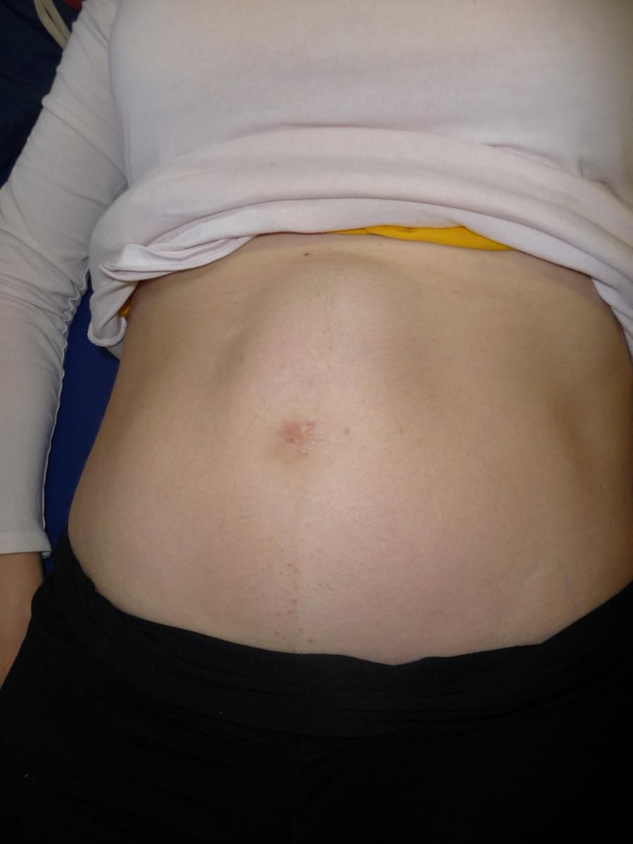 Charakterystyczne dla rozejścia jest tworzenie stożka na brzuchu