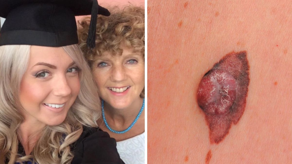 Zamiast kremu do opalania używała... oleju. Agresywny nowotwór okazał się nie do opanowania