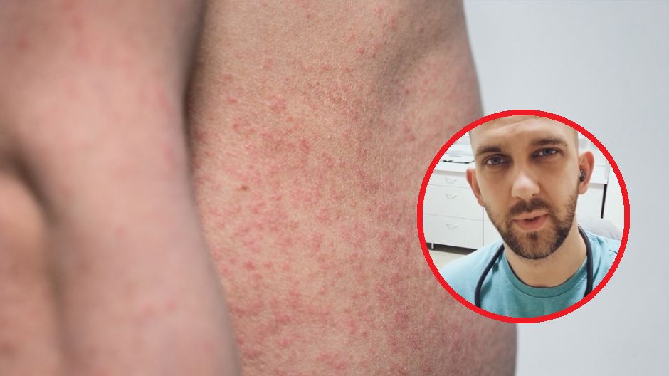 W ubiegłym roku odnotowano 45-krotny wzrost zachorowań na odrę. Czy czeka nas epidemia?