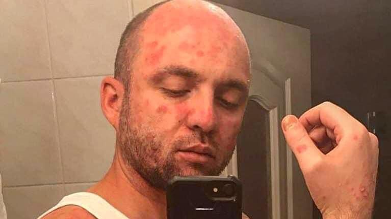 Łuszczyca nie jest chorobą zakaźną