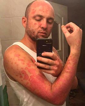 Łukasz Matusik opowiada o walce z łuszczycą i przypomina o swojej akcji #łuszczycaniezaraża