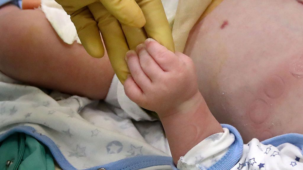 Choroba Kawasakiego i koronawirus mogą dawać podobne objawy