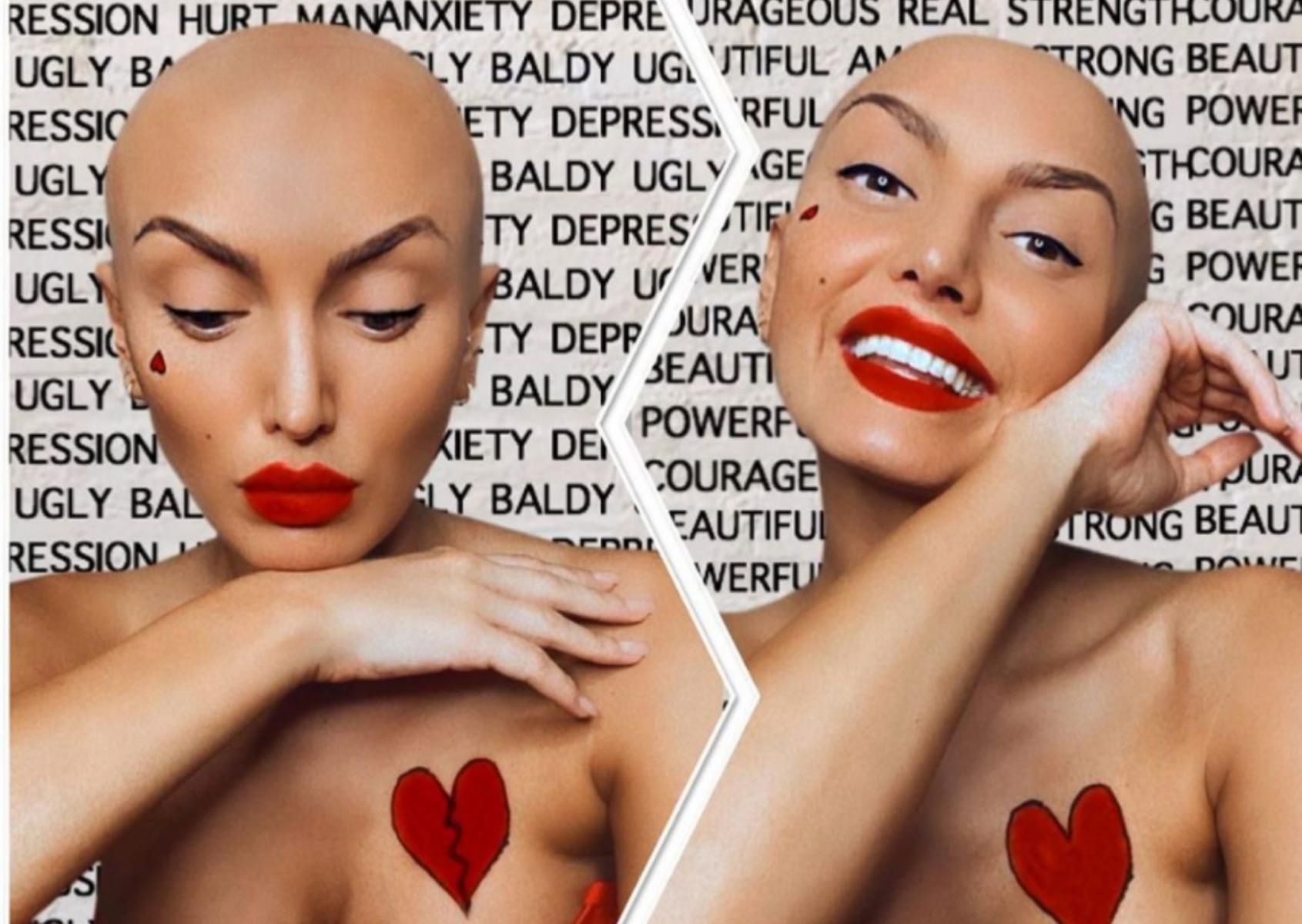 ZaraLana opowiada o łysieniu na swoim Instagramie