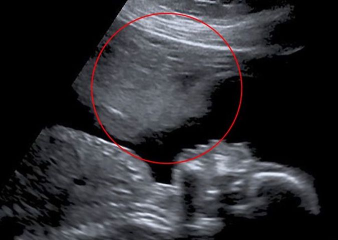 "Anioł stróż" czuwał nad jej ciążą. Niezwykłe zdjęcie USG