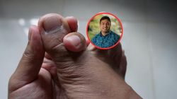 Główna przyczyna dny moczanowej. TikTok wprowadza w błąd ws. leczenia