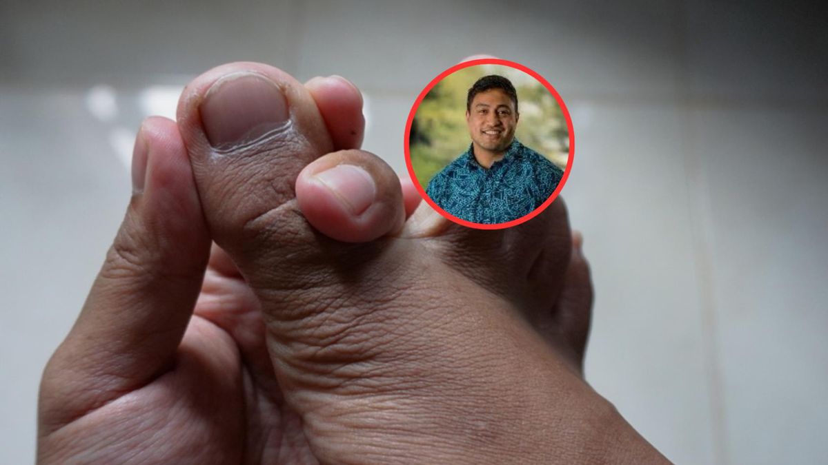 Najbardziej typowy objaw to ostry napad zapalenia jednego stawu