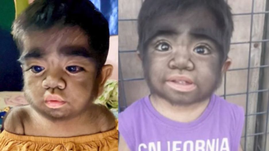 Chłopiec cierpi na "syndrom wilkołaka". Matka była przekonana, że to z jej winy