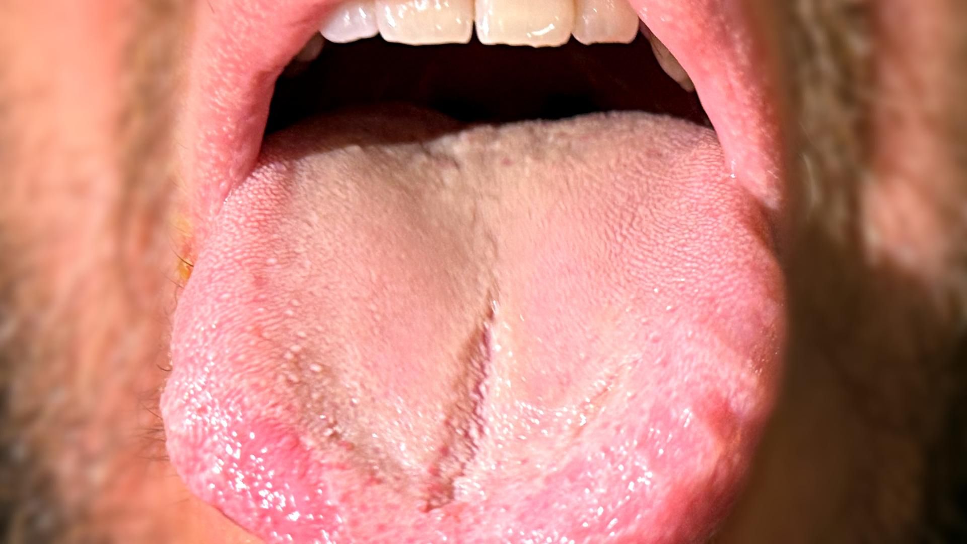 Wygląd języka może sygnalizować problemy zdrowotne, zanim pojawią się inne objawy.