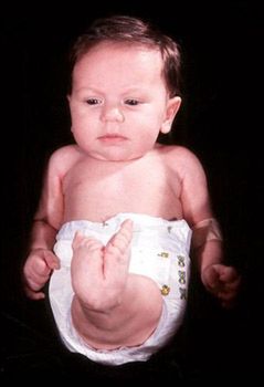 Tiffany Yorks przed operacją, która umożliwiła jej normalne życie