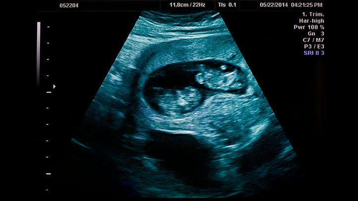 Tragiczna błąd brytyjskich lekarzy. Abortowali zdrowego bliźniaka