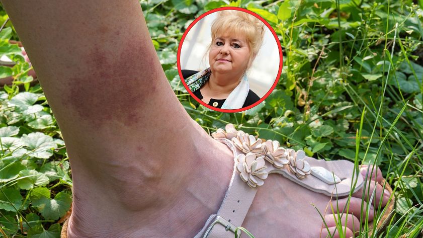 Objawy pojawiają się na policzkach. Choruje coraz więcej dorosłych