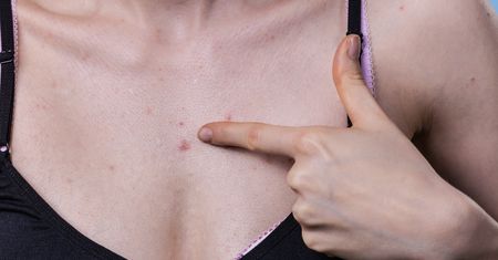 Charakterystyczny objaw na skórze. To znak, że atakuje groźna choroba