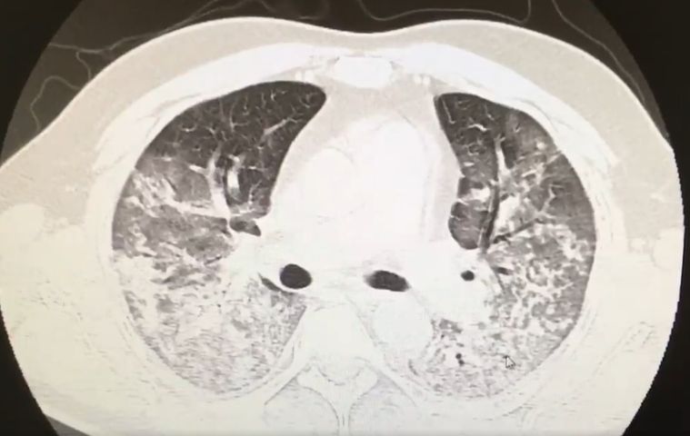 Płuca zaatakowane przez COVID-19