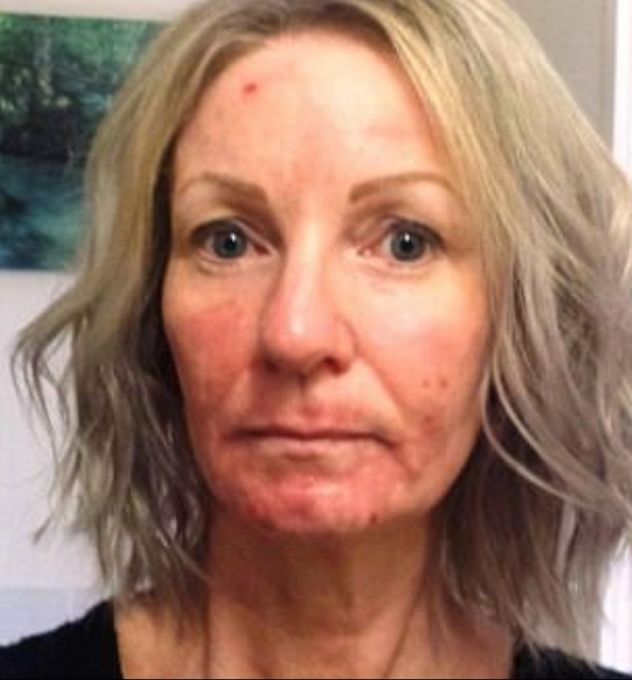 Teraz musi się mocno malować, by zatuszować blizny po oparzeniach