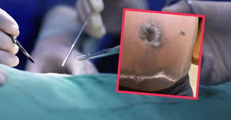 Chciała pięknie wyglądać. Po operacji jej skóra zaczęła gnić
