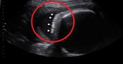 Widzieli już na USG. Matkę wciąż męczyła zgaga